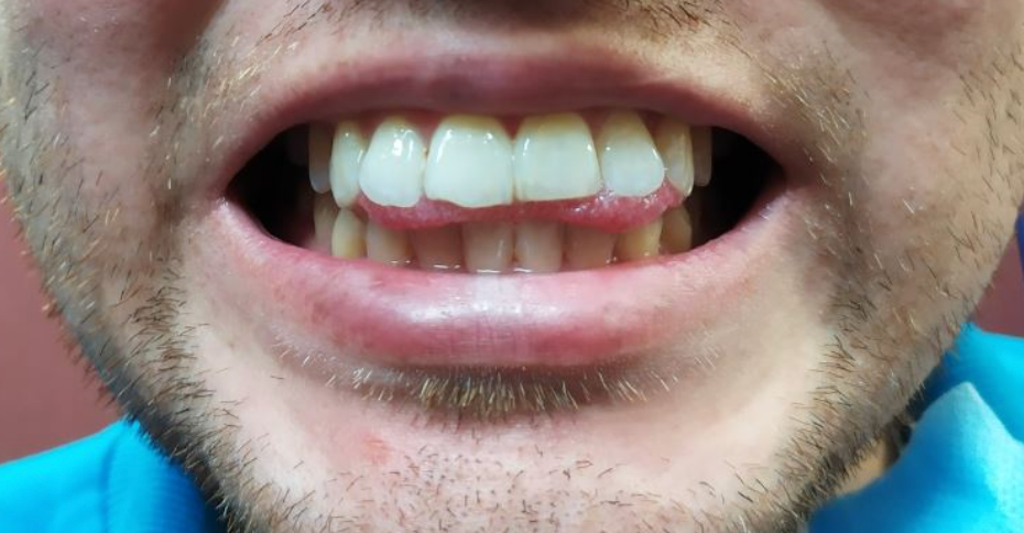 primer plano de un incisivo con un pequeño borde irregular visible en el esmalte
